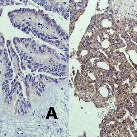 Ihc Original Magnification Staining Of Ovarian Cancer Tissues