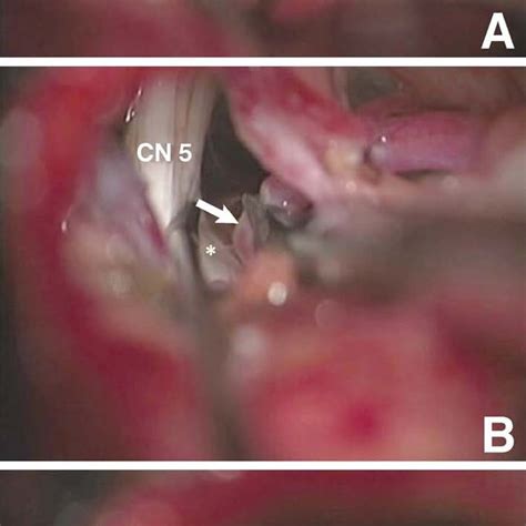 Intraoperative Photographs A Superior Cerebellar Artery Arrow