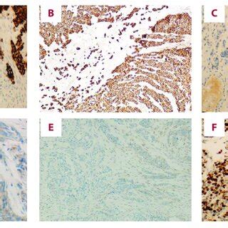 Tumor Cell Are Positive For A CK 7 B CK AE1 AE3 And Negative For