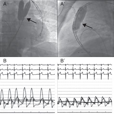 Intervencionismo En Las Cardiopatías Congénitas Del Adulto Revista