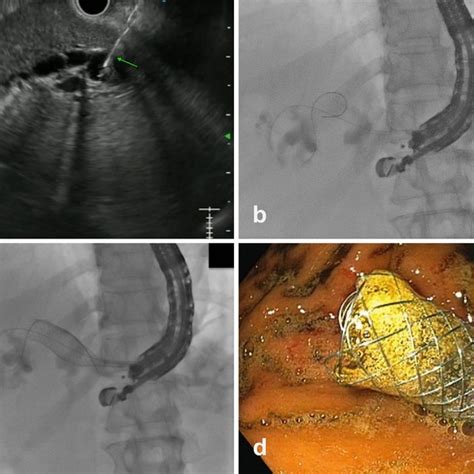 Eus Guided Antegrade Stenting A Duodenal Narrowing In A Patient With