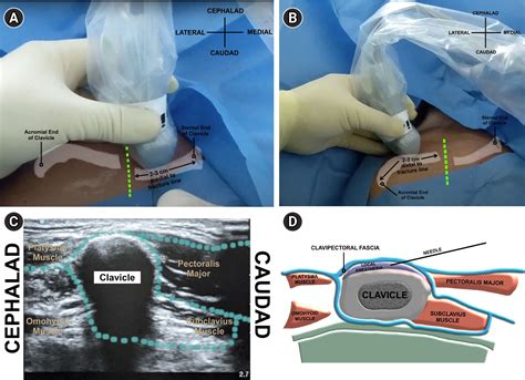 Figure 1 From Clavipectoral Plane Block As A Sole Anesthetic Technique