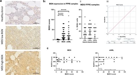 Distinct Bgn Expression In Mds And Aml Bmb A Representative Pictures