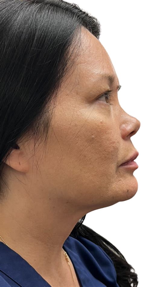 Cosmetic Before And After Photos Franklin Dermatology Group