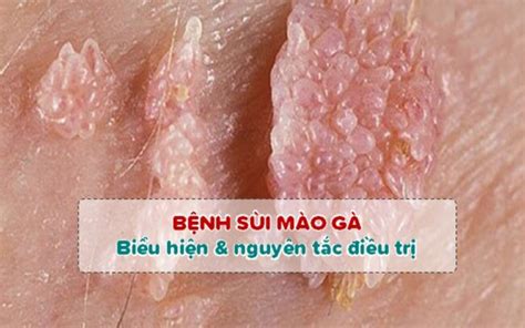 Quy trình đốt sùi mào gà an toàn và uy tín