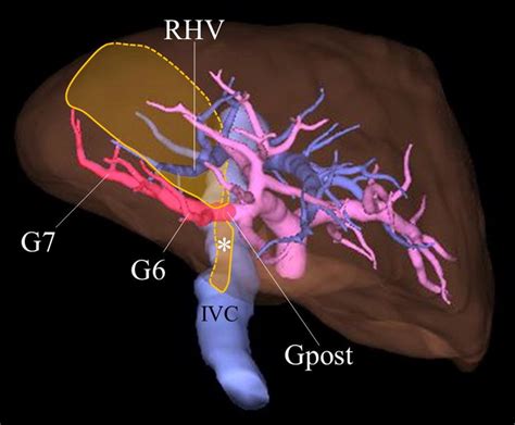 The Right Posterior Glissonean Pedicle Gpost That Crosses Over An