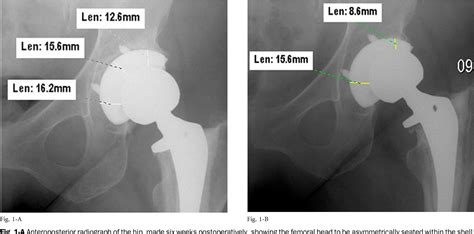 Figure 1 From Early Failure Of A Cross Linked Polyethylene Acetabular Liner A Case Report