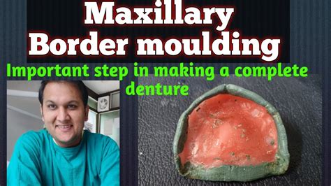 Maxillary Border Molding For Making Complete Denture YouTube