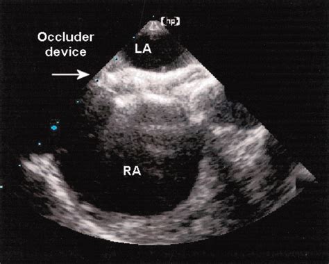 Transesophageal Echocardiography Circulation