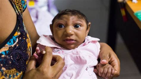 This Study Removes Any Doubt Zika Virus Causes Birth Defect