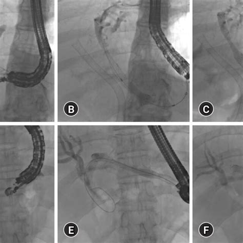 Endoscopic Ultrasound Eus Guided Hepatico Gastrostomy Hgs A C