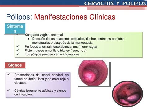 Cervicitis Y Poliposppt Reparado