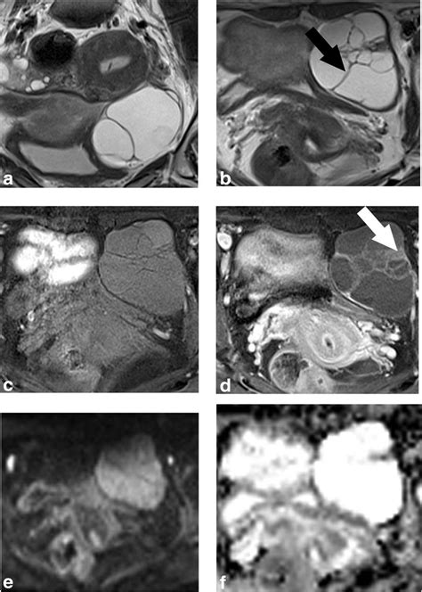 A 34 Year Old Female Histopathologically Confirmed With Benign Mucinous