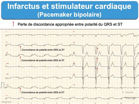 Infarctus 6c Pacemaker E Cardiogram