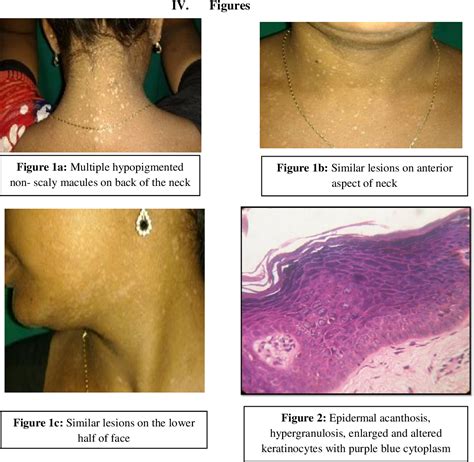 PDF Epidermodysplasia Verruciformis In A HIV Patient A Rare Case