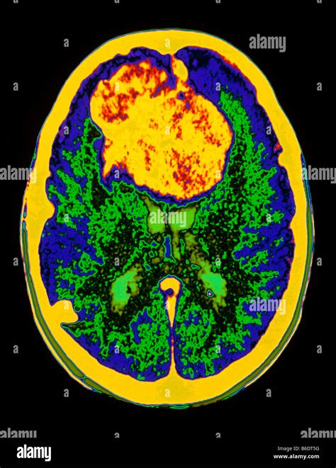 Meningioma. Coloured magnetic resonanceimaging (MRI) brain scan showing a meningioma, a benign ...