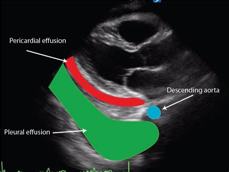 Pericardial Effusion Archives Critical Care Sonography