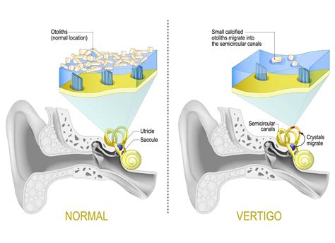 Vertigo Treatment in St. Louis | Vestibular Therapy | Physical Therapy ...