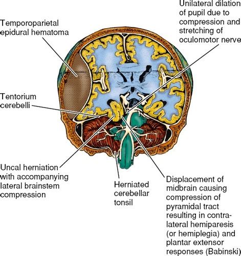 Critical Care Exam Increased Intracranial Pressure Flashcards Quizlet