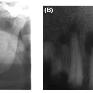 A B Preoperative Panoramic And Periapical Radiographs Showed