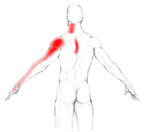 Infraspinatus Muscle Pain And Trigger Points