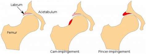 Fai All About Femoral Acetabulum Impingement Markow Training Systems