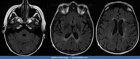 Eighteen Month Follow Up Mri In Man With Susac Syndrome Flair Medlink Neurology