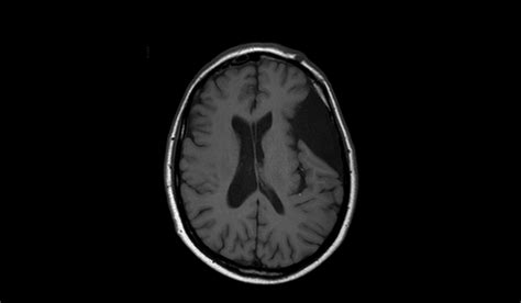 Arachnoid Cyst Mri Radiology Article On Arachnoid Cyst