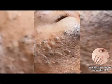 EXTRACTION POINTS NOIRS BLACKHEADS NEWS VIDEOS 2023 YouTube