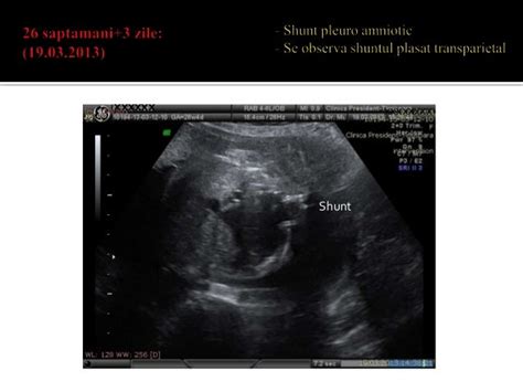 Hidrotorax Fetal Shunt Pleuro Amniotic