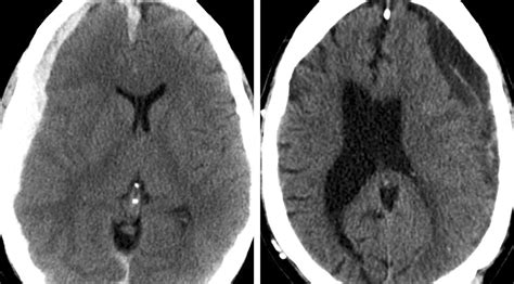 Chronic/Subacute Subdural Hematoma | The Neurosurgical Atlas