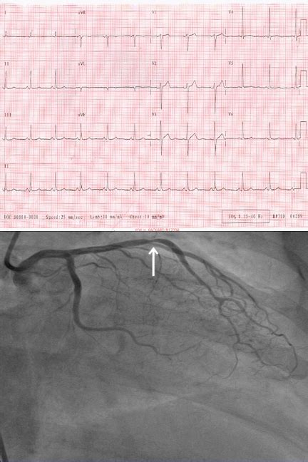 Diagnostic Value Of Electrocardiographic T Wave Inversion In Lead Avl