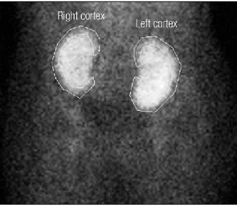 Renogram of dual renal allografts on posttransplant day 2, consistent ...