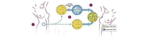 Process Of The Cell Assisted Lipo Transfer Cal Liposuction