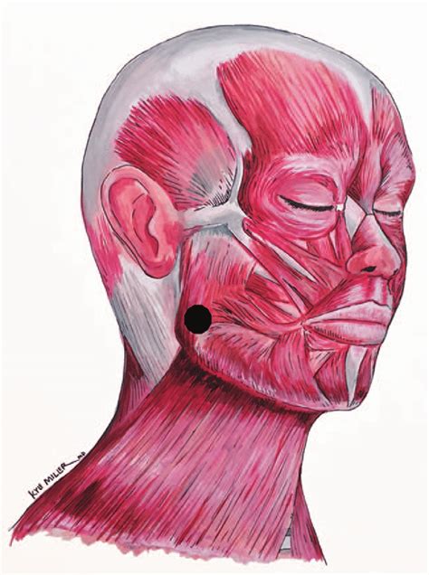 Typical Injection Sites For Treatment Of Masseteric Hypertrophy Download Scientific Diagram