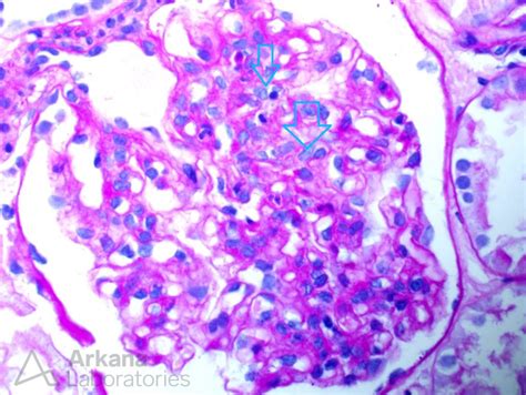 Infection Associated Glomerulonephritis Teaching Point Arkana Labs