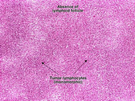 Non-Hodgkin Lymphoma Wiki