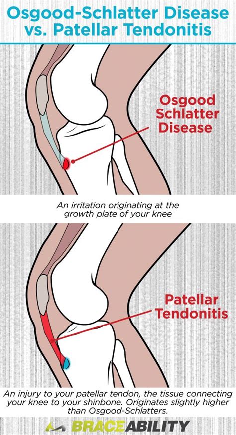 Osgood Schlatter Disease in Adults: Treatment for Knee Pain