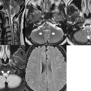 Pdf Characteristic Mr Imaging Features And Serial Changes In Adult