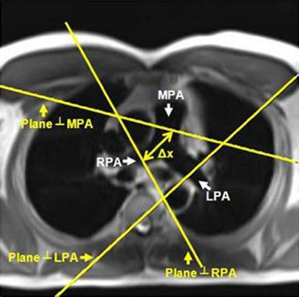 Planning Of The Pulmonary Flow Imaging Planes An Axial Slice Showing