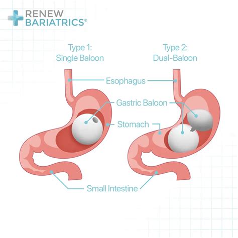 Gastric Sleeve Vs Gastric Balloon Renew Bariatrics