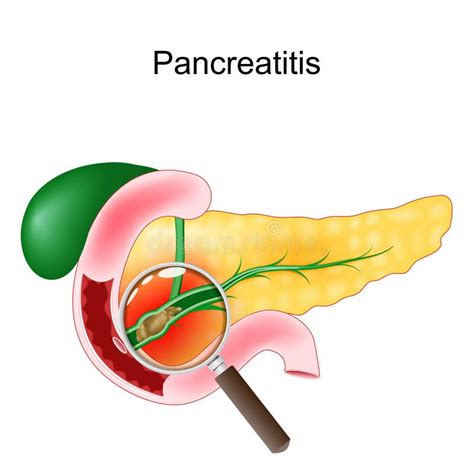 Acute Pancreatitis Close Up Of A Realistic Pancreas Duodenum And