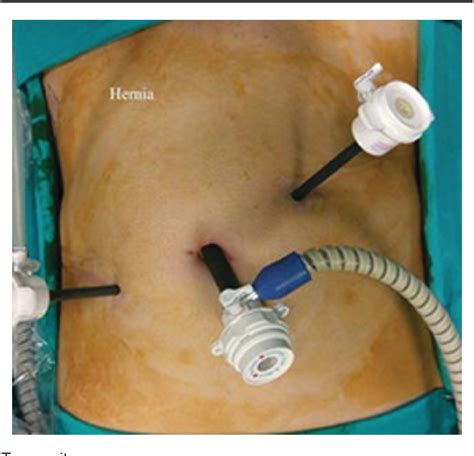 Figure 1 From Impact Of Mesh Fixation Vs Non Fixation In Laparoscopic Transabdominal