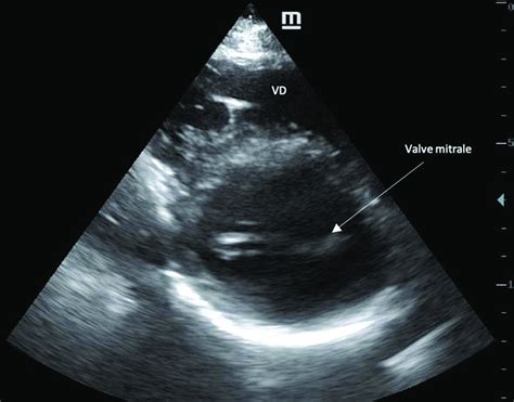 Valve Mitrale En Vue Parasternale Axe Court Noter La Valve Mitrale En