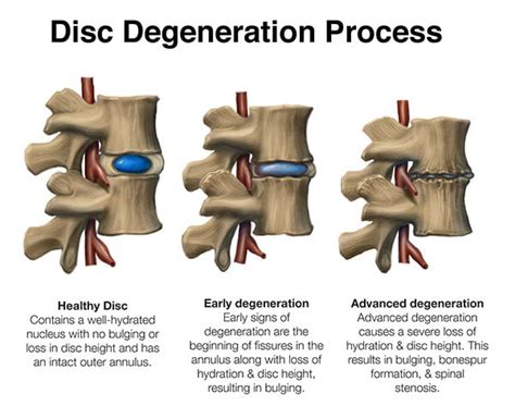 Via Disc Np Allograft Pain Management Nyc