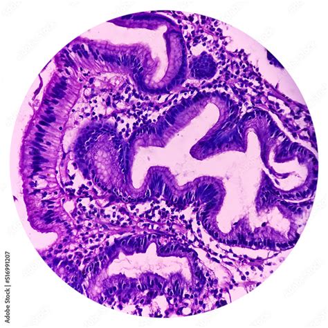 Microscopic Image Of Gastric Carcinoid Tumor Rare Tumors That Develop