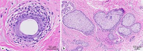 Figure 2 From Erythematous Papules Involving The Eyebrows In A Patient With A History Of Rosacea