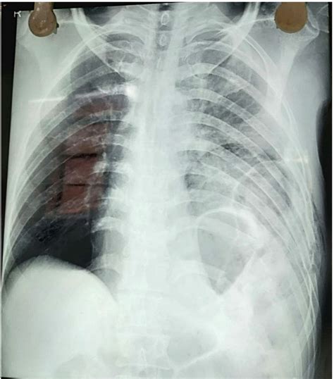 Chest X Ray Posteroanterior View Showing Normal Right Lungs And Loss