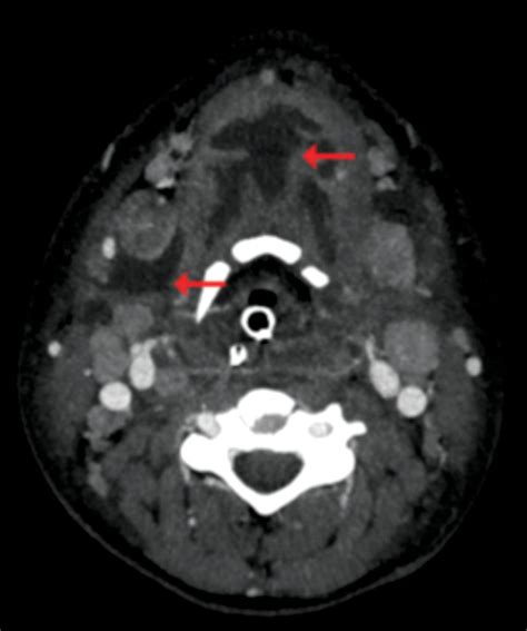 Ludwigs Angina A Case Report Oral Health Group