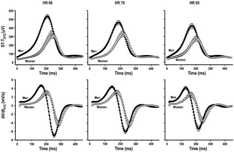 Sexual Dimorphism In The Electrocardiographic Dynamics Of Human